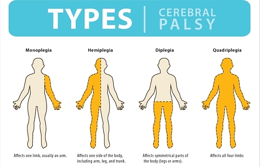 TargetWalk's tweet photo. Physiotherapy clinic for cerebral palsy treatment target walk gurugram https://t.co/lDX7gXzzBa