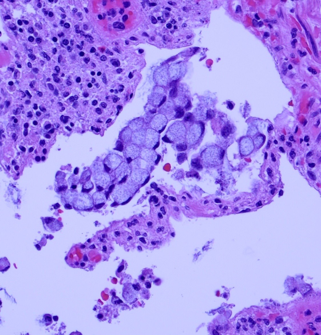 A short  #GIpath  #tweetorialA concerning finding on a colon resection... @ariella8  @nucleololailo  @DrGeeONE  @kis_lorand  @MAHoureih  @D4L14H  @DraEosina  @SingJamieD  @Pathmath1  @ALBoothMD  @jansen_marnix  @steland011  @Mvgs1706  @RunjanChetty  @drtimbracey  @AllonKahn