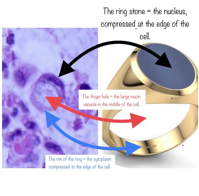 @jake_bledsoe  @natzpat  @Dr_Brian_Cox  @TristanRutland7  @CArnold_GI  @slusagar  @RZitwer Some of these cells are showing classic ‘signet ring’ morphology: