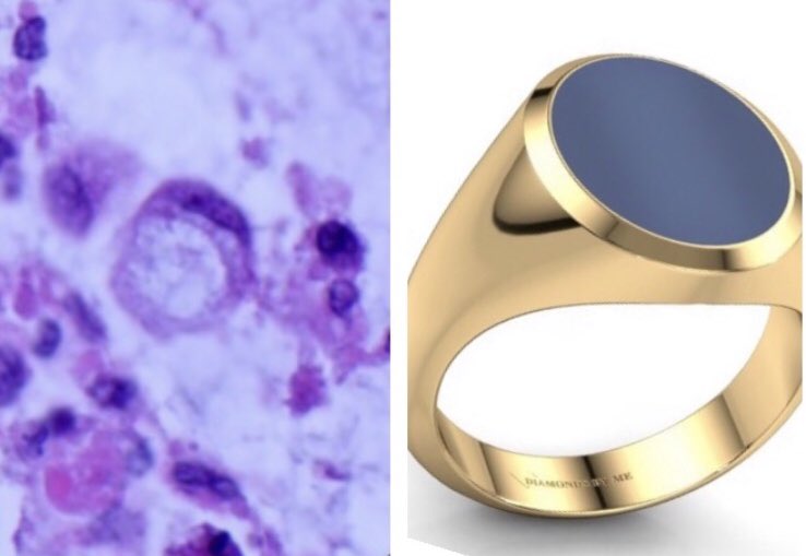  @jake_bledsoe  @natzpat  @Dr_Brian_Cox  @TristanRutland7  @CArnold_GI  @slusagar  @RZitwer Some of these cells are showing classic ‘signet ring’ morphology: