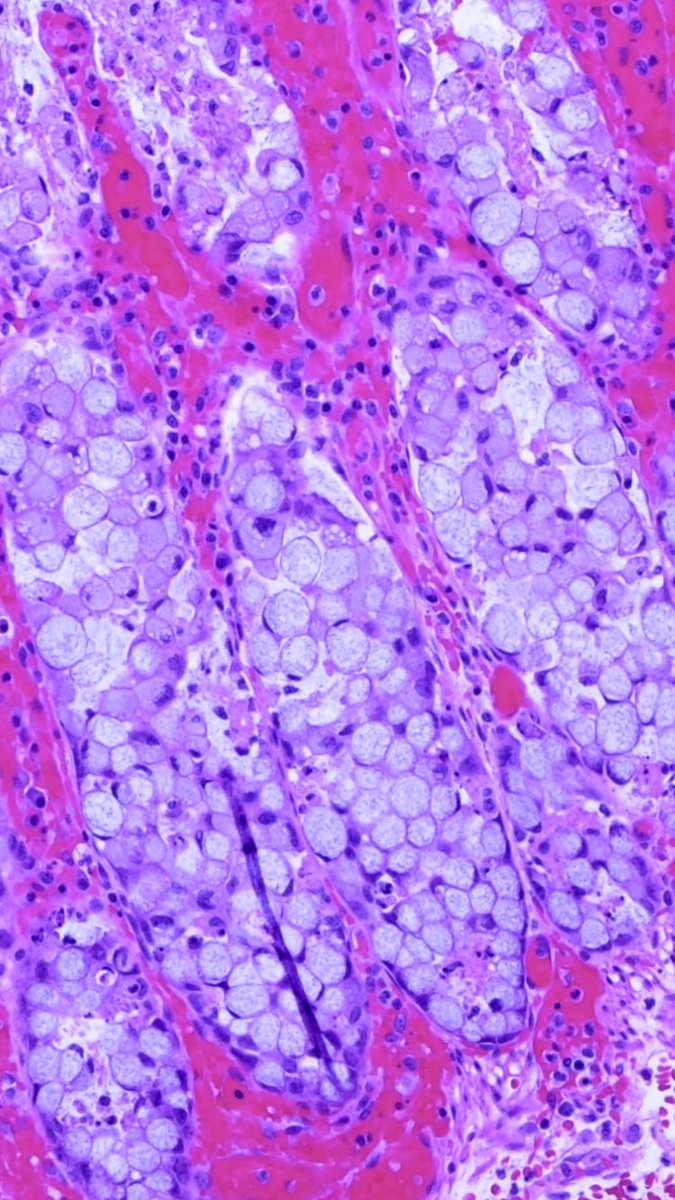 Before we sign it out as “invasive signet ring carcinoma”, let’s take a look at lower power: