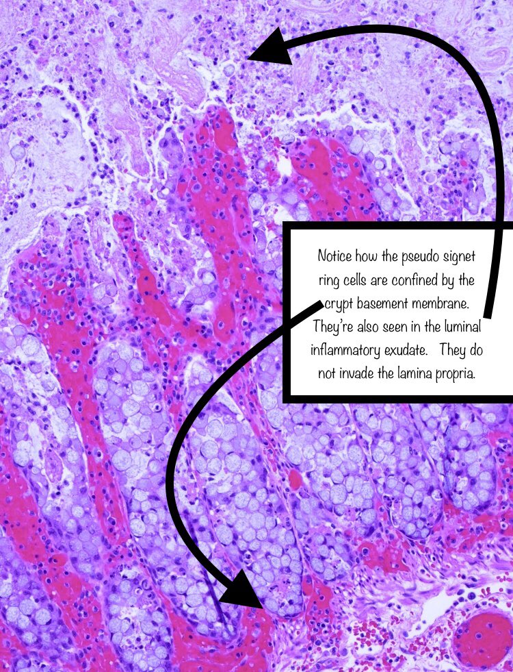 The cause of signet ring cell change isn’t completely understood. Apparently, mucosal inflammation and ischemia cause epithelial cells to slough and ‘round up’, resulting in signet ring-like morphology.For more detail see  https://pubmed.ncbi.nlm.nih.gov/11257633/&nbsp;