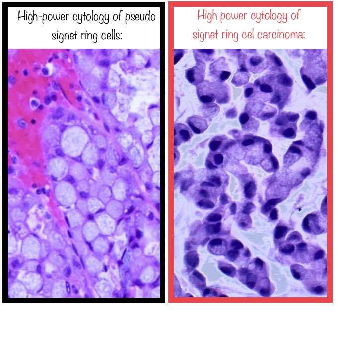Contrast the nuclear features of signet ring cell change with those of adenocarcinoma.
