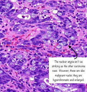 Contrast the nuclear features of signet ring cell change with those of adenocarcinoma.