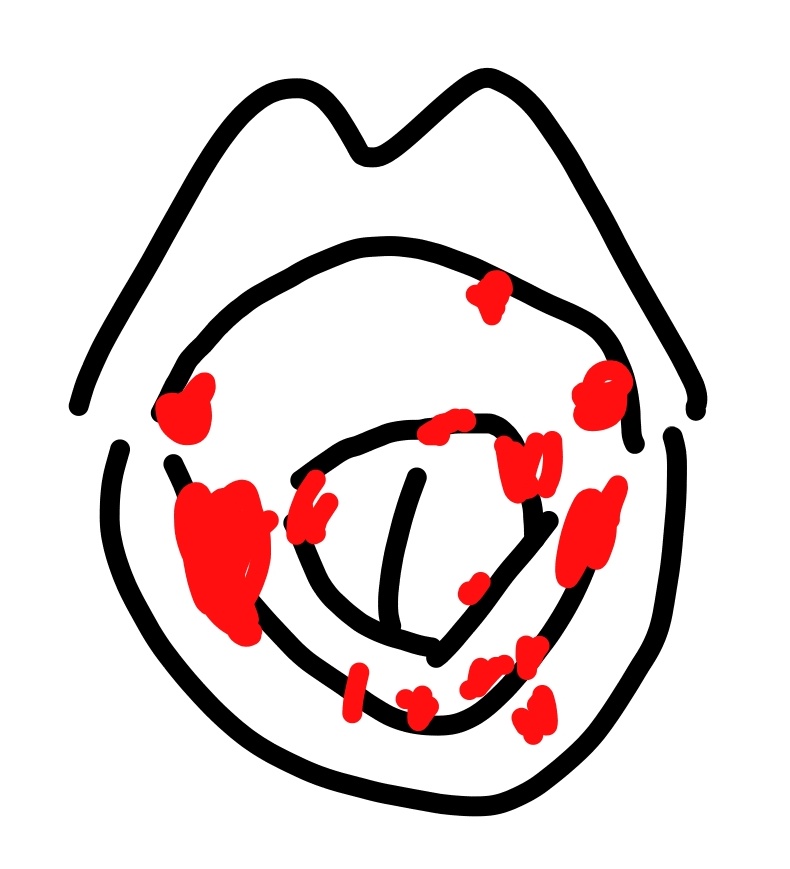 イカぽ 2787 8175 0306 写真貼りたいけどグロ認定されそうやから描いたミィ いまミィがかかってる手足口病は 手足のブツブツと 口内炎がこのくらい できます ナウで口内炎が生えてきます ウイルス性なので薬も無いらしく 免疫高めて自己治癒しかない イカぽ 2787 8175 0306 写真貼りたいけどグロ認定されそうやから描いたミィ いまミィがかかってる手足口病は 手足のブツブツと 口内炎がこのくらい できます ナウで口内炎が生えてきます ウイルス性なので薬も無いらしく 免疫高めて自己治癒しかない