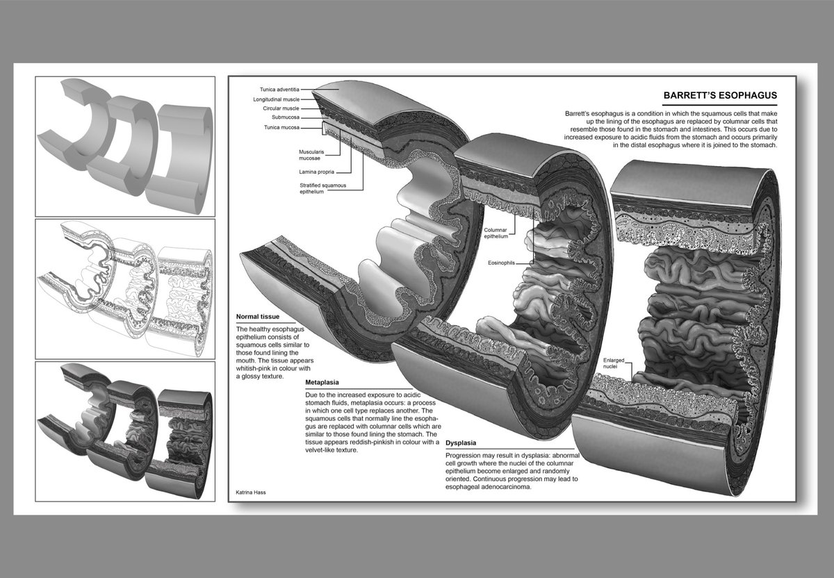 Here’s a pathology spread I made on Barrett’s Esophagus! Created with <a href="/Procreate/">Procreate</a>, Photoshop, and Illustrator.
.
#sciart #mscbmc #scientificart #pathology #medicalillustration #scicomm #photoshop #anatomy #editorialillustration #biology  #digitalart #digitalpainting #medart