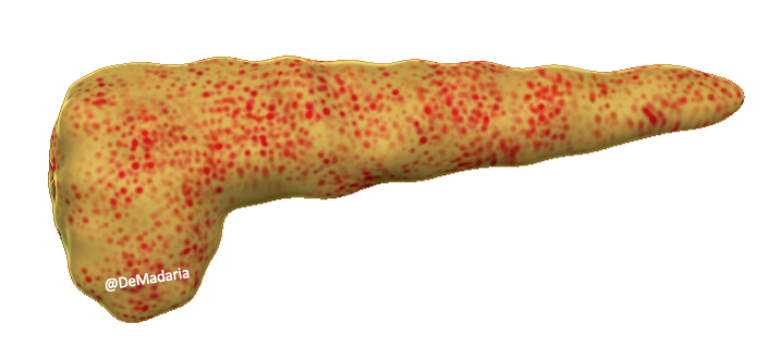 Those postulates can’t be applied to the relationship between  #COVID19 and pancreatitis, as this is apparently a very infrequent complication. We have to look for other postulates addressing more subtle associations between exposition to an agent and disease