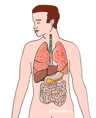 Pancreatitis is not more frequent in patients with higher viral load, at least this is suggested by the fact that many patients had pancreatitis in mild  #COVID19 disease, so BH BIOLOGICAL GRADIENT 