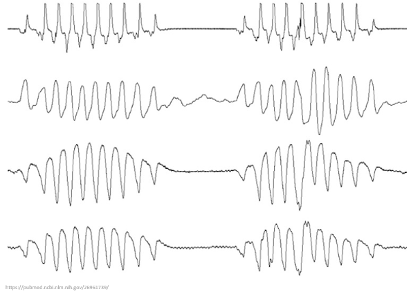 1/17Why do patients with advanced heart failure often develop the Cheyne-Stokes breathing pattern?To understand this phenomenon we'll have to explore circulatory flow time and the concept of loop gain. And no this tracing isn't Torsades de Pointes  #tweetorial  #medtwitter