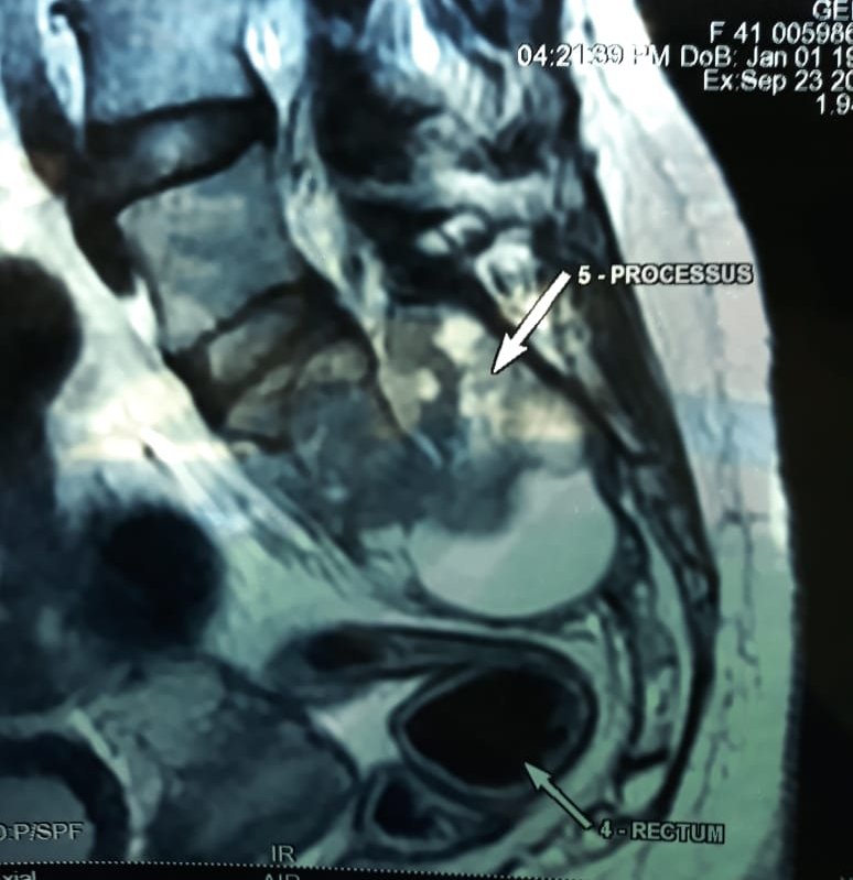 cherradi07's tweet photo. Good afternoon. Please I need your opinion. 41 years old women. Dorsal pain.Sacral processus centered on the medullary canal and invaded soft tissue and vertebrea.biopsy.mucoid material. https://t.co/cvE7VD47YF