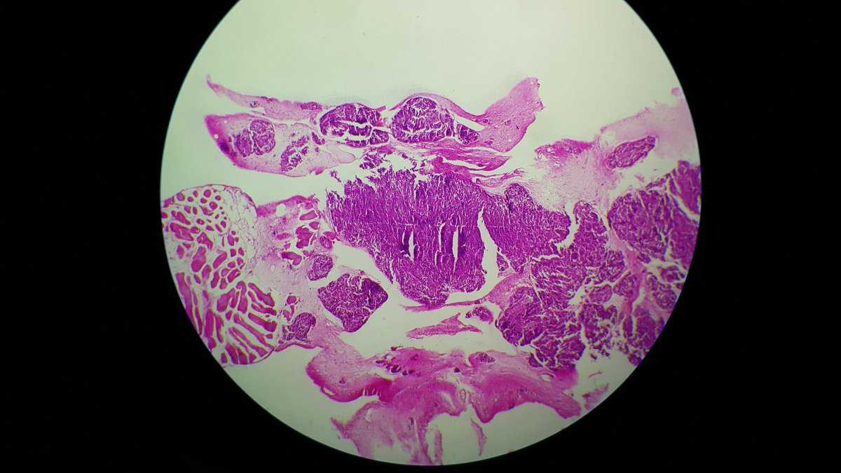 cherradi07's tweet photo. Good afternoon. Please I need your opinion. 41 years old women. Dorsal pain.Sacral processus centered on the medullary canal and invaded soft tissue and vertebrea.biopsy.mucoid material. https://t.co/cvE7VD47YF