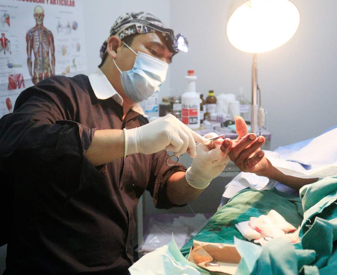 DrPretell's tweet photo. Realizando atención por una #fractura de falange distal del 2do dedo de la mano y una ruptura total del flexor. El procedimiento a seguir fue una tenorrafía y reducción más fijación #Ortopedia #Traumatología #Cirugía
📌Clínica Provida - Chiclayo.
📱Cel. 969295738 https://t.co/TODKVLGlNq