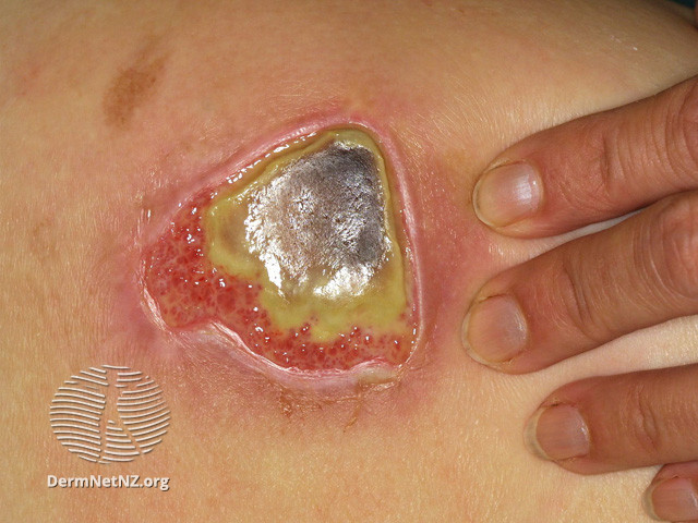 1/Today, a brief  #dermtwitter  #tweetorial on a topic particularly important during the  #COVID19  #pandemic:PRESSURE ULCERS (PU)! #MedEd  #FOAMEd  #medtwitter  #nursetwitter  #medstudenttwitter  #dermatology No COIPC:  @dermnetnz and  @grepmeded