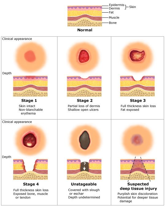 Ischemia is the most important contributor to PU. The interruption of blood flow leads to tissue necrosis. PU are staged based on depth from 1 (non-blanching erythema) to 4 (bone/tendon exposed), and suspected deep tissue injury or when the PU is unstageable. PC:  @uptodate
