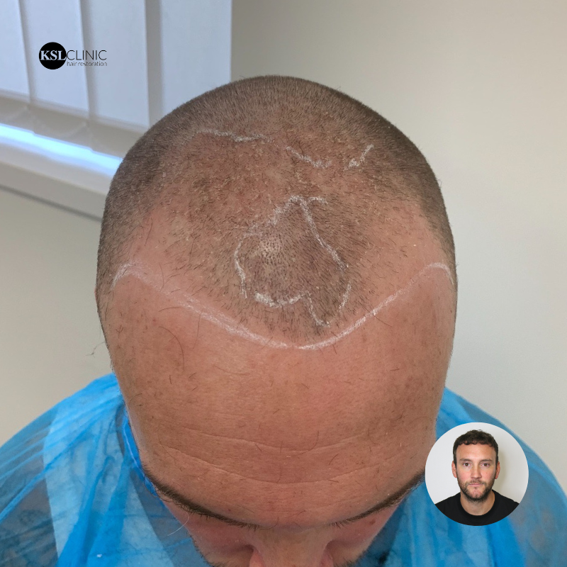 KSL_Clinics's tweet photo. Jay came in for his 12 month review following his FUE Hair Transplant at KSL Clinic
👀 Scroll for 𝐛𝐞𝐟𝐨𝐫𝐞 𝐚𝐧𝐝 𝐚𝐟𝐭𝐞𝐫 pictures from 𝘢𝘭𝘭 𝘢𝘯𝘨𝘭𝘦𝘴
We’re answering all questions in regards to anything hair related - DM today 📩
#KSLClinic #DrMatee #FUE https://t.co/BijQuGcqSW