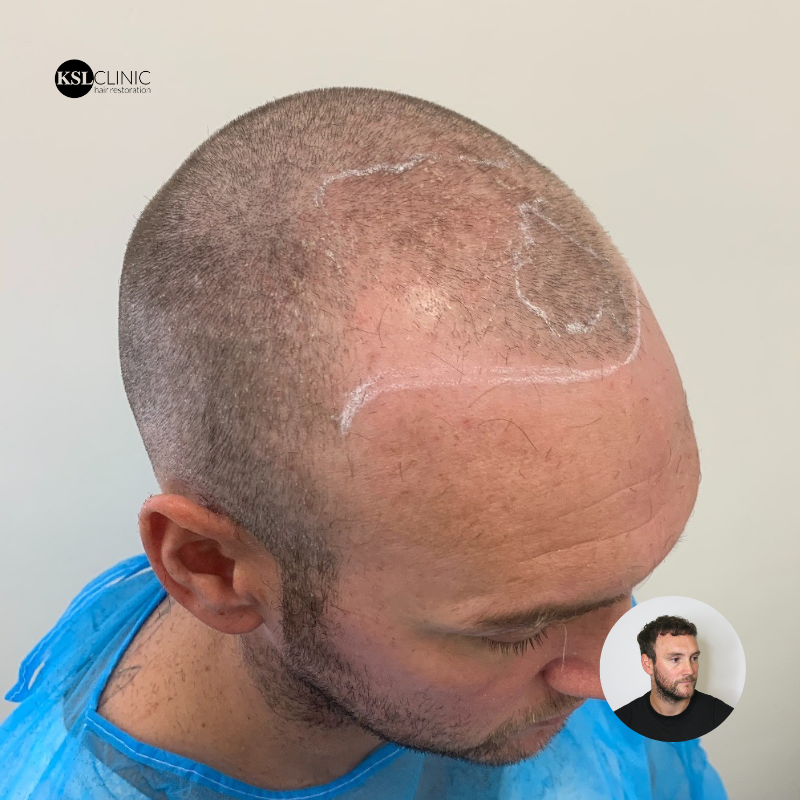 KSL_Clinics's tweet photo. Jay came in for his 12 month review following his FUE Hair Transplant at KSL Clinic
👀 Scroll for 𝐛𝐞𝐟𝐨𝐫𝐞 𝐚𝐧𝐝 𝐚𝐟𝐭𝐞𝐫 pictures from 𝘢𝘭𝘭 𝘢𝘯𝘨𝘭𝘦𝘴
We’re answering all questions in regards to anything hair related - DM today 📩
#KSLClinic #DrMatee #FUE https://t.co/BijQuGcqSW