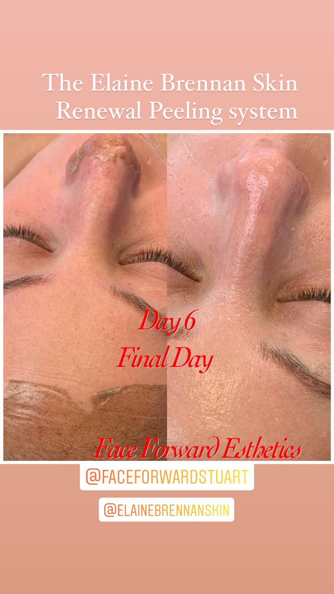 FaceForward10's tweet photo. New, fresh, bright and healthy skin
After 6 days down time.
Results will Continue to build over the next 2 to 3 months. Ultimately for 12 months after The Elaine Brennan Skin Renewal Peeling process.
Clients committed to 7 days following our instructions. https://t.co/9dayCXKCXR