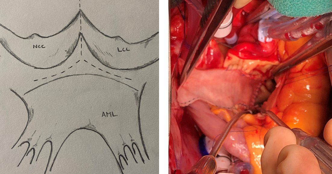 We developed a new technique, a "Y" incision and rectangular patch to enlarge the aortic annulus by 2-3 valve size without cutting into the MV, RVOT, or LA. it is very effective and safe. Paper published in JTCVS Tech.  sciencedirect.com/science/articl…
CentralFigure.tif