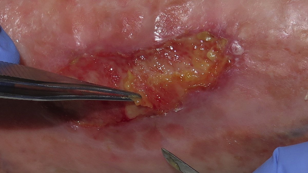 8/If chemical debridement doesn’t work, mechanical debridement can be done at the bedside with local anesthesia (see pic). If something more extensive is required, the OR may be required for deeper debridement with possible vac dressing or grafts.PC:  https://www.elenaconde.com/en/fibrinous-tissue-in-venous-ulcers-what-are-we-talking-about/