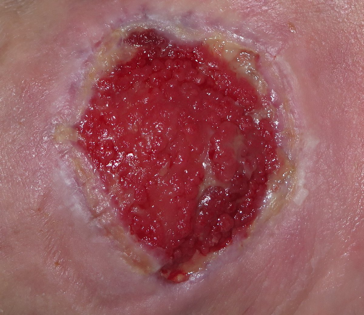 10/ A couple unique scenarios:Superinfection: topical antibiotics help clear it quickly. Topical metronidazole is good with anaerobes. Topical mupirocin is my go-to for gram positive organisms.Granulation tissue (pic) that impedes healing: some AgNO3 sticks do the trick!