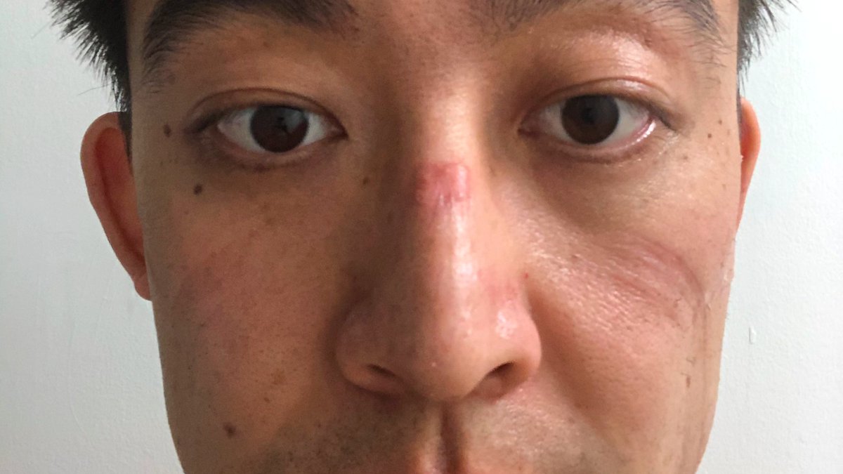 11/And a quick word for all the healthcare workers with n95 induced PU on the nasal bridge. As above, a foam dressing may help it feel better BUT this can change the n95 fit, so it’s important to get re-fit tested with whatever dressings you are using!