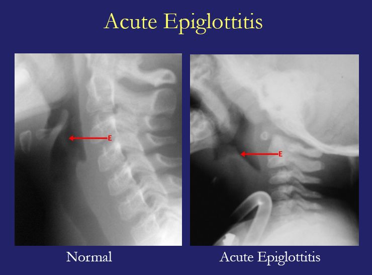 Some medical historians argue that from the description of Washington's illness that he may have been suffering from acute epiglottitis, which can obstruct the airway. Tx now is antibiotics and tracheotomy in life-threatening cases. Common bug was H influenzae. 12/