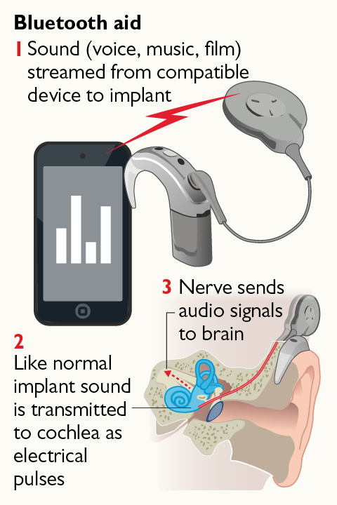 There are Cochlear implants which have bluetooth support. You can just pair your implant to your phone.