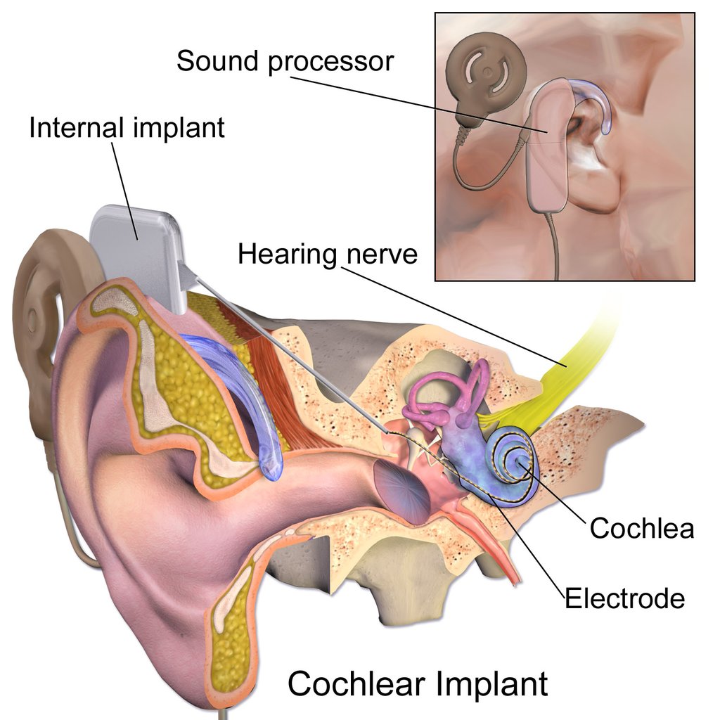 So instead of stimulating the parts of your ear that hear (the parts that convert sound waves into electrical signals), they go directly to the cochlear nerve and stimulate it directly. So it's closer to an aux cable than a hearing aid.