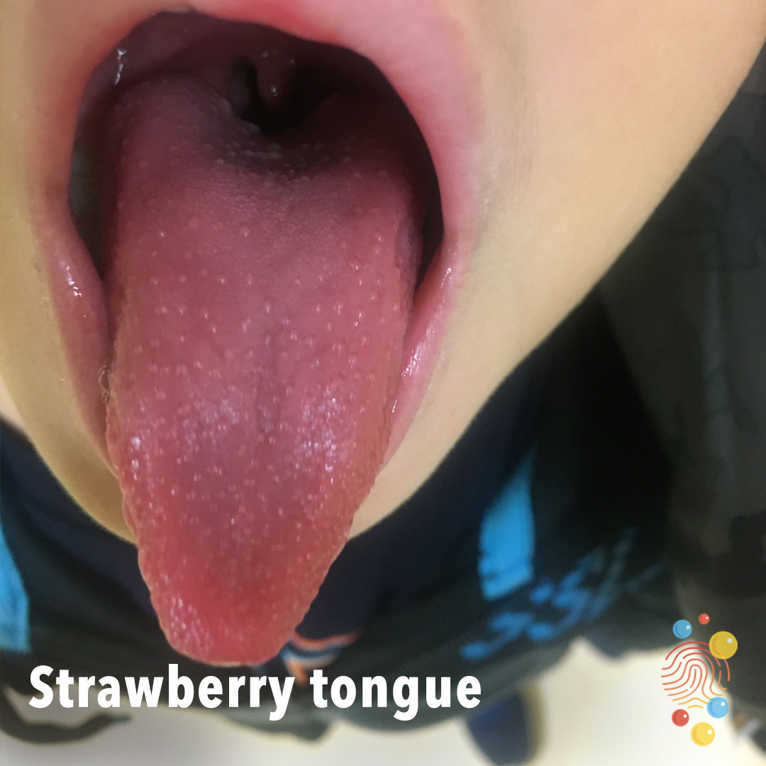 DFTBSkinDeep's tweet photo. Can you name same causes for a strawberry tongue? 🍓

The image shows tiny red spots on the tongue.

Learn more https://t.co/UKkXQnApR6

@rcpch_trainees @PemTrainingUK @RoySocMed @DFTBubbles @WeCYPnurses 
#skindeep #FOAMed #FOAMped #dermtwitter #medtwitter https://t.co/mGvuYjEIc4