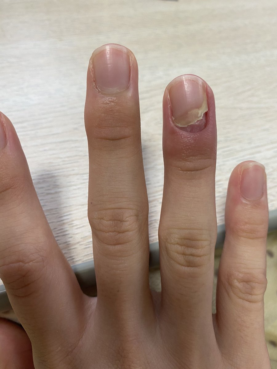 ジヤモウ 10月17日 10月18日 10月日 10月21日 腫れより爪の傷みが気になって仕方がない 下の皮膚は固くなってた こうやって爪が出来ていくんだと学んだ