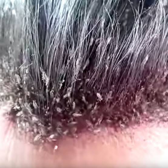 The causative fungus usually penetrates deep into the hair follicles so may be difficult to treat with Topicals alone.4) Head Lice-Lice are tiny, wingless, parasitic insects that feed on human blood. Lice are easily spread through close personal contact and by sharing 3/8