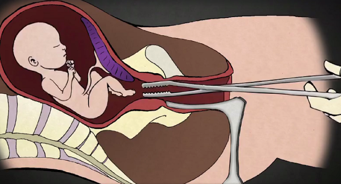 LifeNewsToo's tweet photo. 20 States Ask Supreme Court to Ban Dismemberment Abortions Tearing Off Babies’ Limbs https://t.co/N090Vbwemy https://t.co/a3Wf4LGQWN