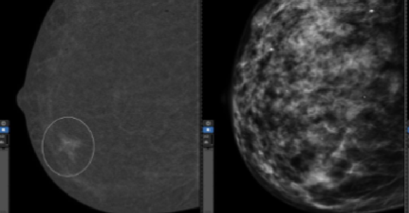 GEHealthCare's tweet photo. In the U.S. women often have to wait many weeks for their breast cancer diagnosis and treatment plan. @MyStLukes is ready to change that, piloting the nation’s first One-Stop Clinic aimed at achieving faster breast cancer diagnosis with a care team at one location. @PremierHA