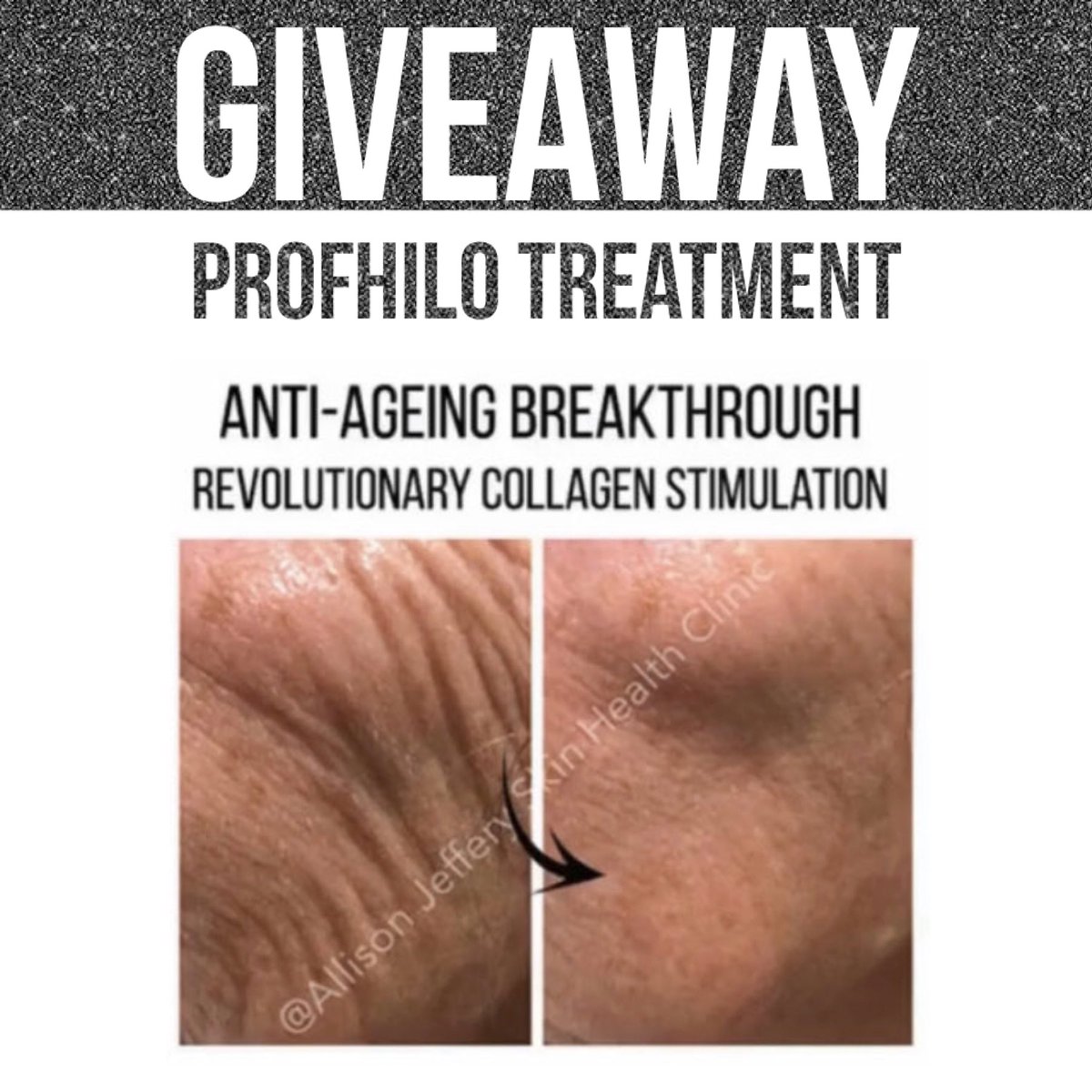 AllisonJeffery_'s tweet photo. PROFHILO ™️ CHRISTMAS GIVEAWAY! 
You could win A Profhilo treatment for yourself or as a gift!
1. Like this post 
2. Retweet this post 
3. Make sure you’re following us

Winner will be picked on Wednesday 16th Dec!18+ only https://t.co/kRwhGXSFXa