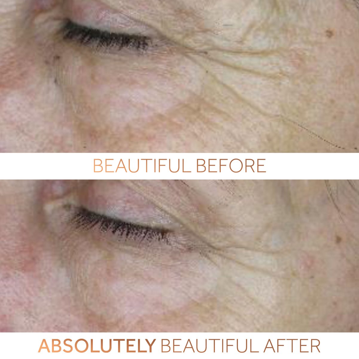 Isn't it incredible when you can see AND feel results!? 

This was a before/after photograph from our clinical trial using Maxerum, our newest collagen-boosting serum. 

Amazingly, we found out that Maxerum reduces wrinkles by 18% in just 28 days. 😲