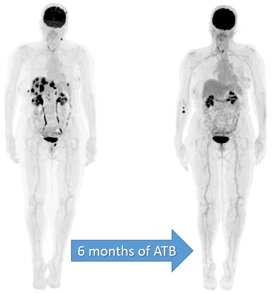 79yo F w/ weight loss and liver nodules. 

☢️ PET/CT - lung, liver, spleen, adrenal and kidney metabolic hypovascular lesions

🔬Tuberculosis

📝 FDG-PET is a good method for therapy assessment in chronic inflammatory / infectious disease 

<a href="/SNM_MI/">SNMMI</a> @officialEANM