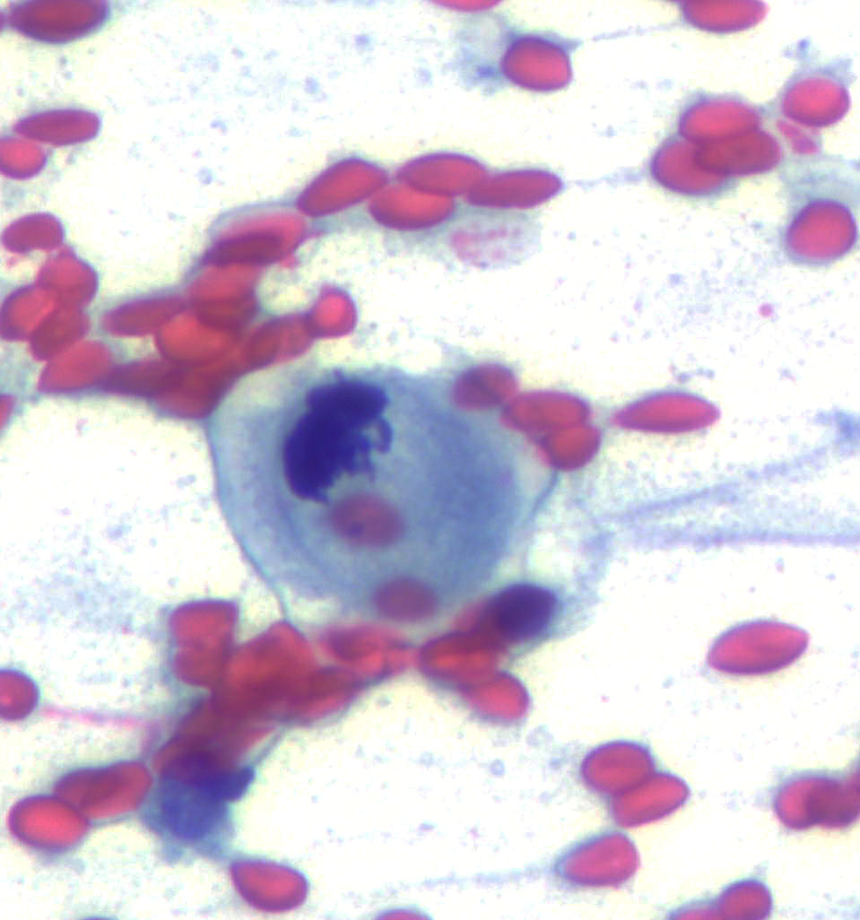 mdlozanoe's tweet photo. Retroperitoneal LN metastasis of a gastric AC. One mitosis looks like a bug and another one like a squashed bug 🕷️
#Cytopath #Pathresidents #CunPath https://t.co/UKiqu0uwi3