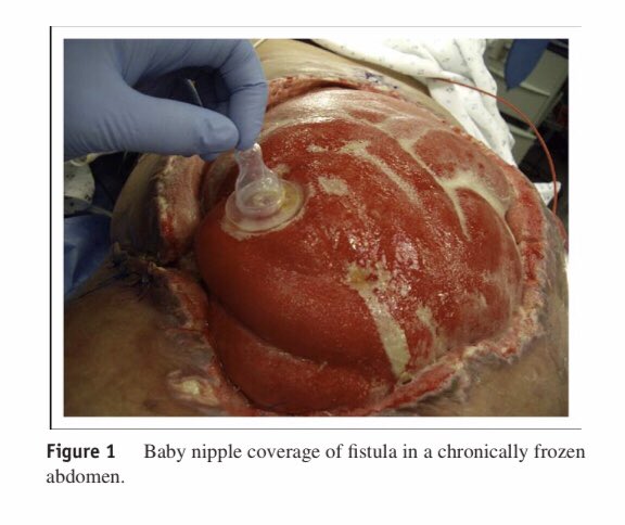 AmJSurgery's tweet photo. Pacifying the open abdomen with concomitant intestinal fistula: The Nipple Technique! Step by Step! #SoMe4Surgery #MedTwitter @pferrada1 @pturnermd @JFreischlag @JJcolemanMD @juliomayol @SWexner @PipeCabreraV @TomVargheseJr @NeilFlochMD @Cirbosque @MISIRG1 https://t.co/4hr5z7AVvG
