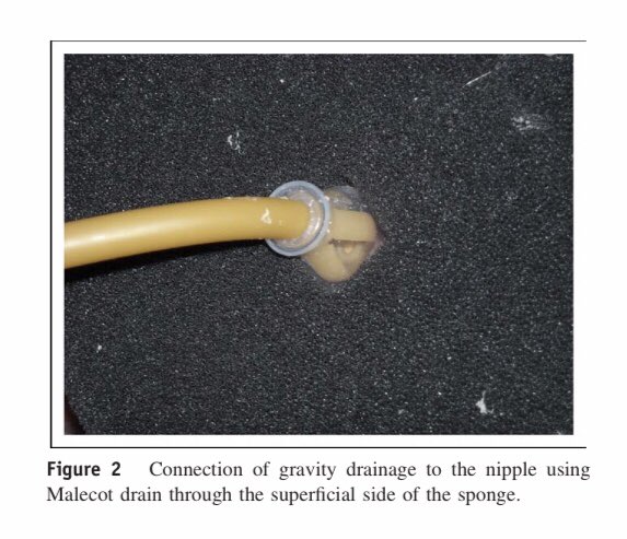 AmJSurgery's tweet photo. Pacifying the open abdomen with concomitant intestinal fistula: The Nipple Technique! Step by Step! #SoMe4Surgery #MedTwitter @pferrada1 @pturnermd @JFreischlag @JJcolemanMD @juliomayol @SWexner @PipeCabreraV @TomVargheseJr @NeilFlochMD @Cirbosque @MISIRG1 https://t.co/4hr5z7AVvG