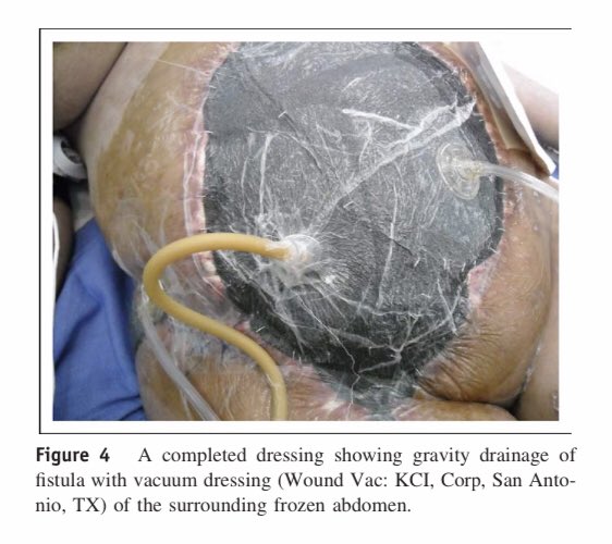 Pacifying the open abdomen with concomitant intestinal fistula: The Nipple Technique! Step by Step! #SoMe4Surgery #MedTwitter <a href="/pferrada1/">Paula Ferrada MD FACS FCCM MAMSE</a> <a href="/pturnermd/">Patricia L. Turner, MD, MBA, FACS</a> <a href="/JFreischlag/">Julie Freischlag, MD</a> <a href="/JJcolemanMD/">Jamie Coleman, MD FACS</a> <a href="/juliomayol/">Julio Mayol</a> <a href="/SWexner/">Steven D Wexner MD, PhD</a> <a href="/PipeCabreraV/">Dr Luis Felipe Cabrera Vargas MD FACS</a> <a href="/TomVargheseJr/">Tom Varghese Jr. MD, MS, MBA, FACS, MAMSE 🇺🇸</a> <a href="/NeilFlochMD/">Neil Floch MD</a> @Cirbosque @MISIRG1