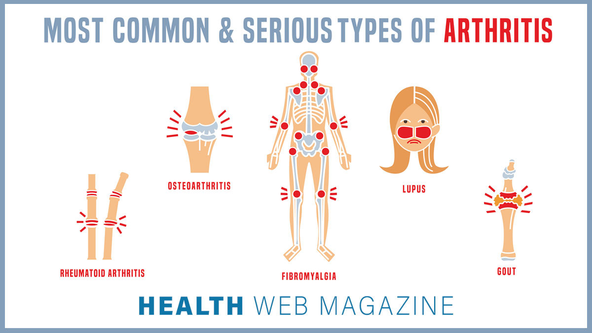 HealthWebMagaz1's tweet photo. Knowing exactly what type of arthritis you have helps you find the most effective treatment!

#HealthWebMagazine
.
.
.
#hwm #arthritis #jointpain #TypesOfArthritis #backpain #osteoarthritis #rheumatoidarthritis #gout #Fibromyalgia #lupusawareness #lupus #SeriousDisease #health https://t.co/5Nhnss6Jna