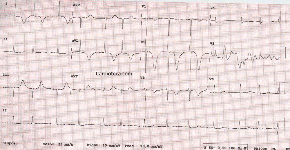 cardioteca's tweet photo. #ECGCardioTeca 402 - Paciente de 88 años, acude por dolor torácico de 48h. No quería venir al hospital porque tiene a su marido enfermo ingresado en otro hospital. El diagnóstico más probable es... 

🧐Anímate a dar tu diagnóstico en: https://t.co/r5DfId2s25
#ecg #cardiologia https://t.co/Z6GQs06knP