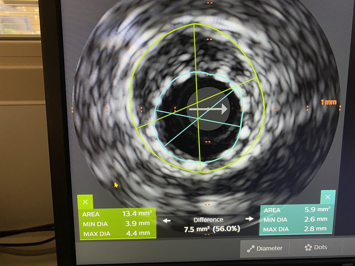 IVUS showed prior LAD 2.75mm stent in 4.25 vessel and 4.5mm in more Prox segment.