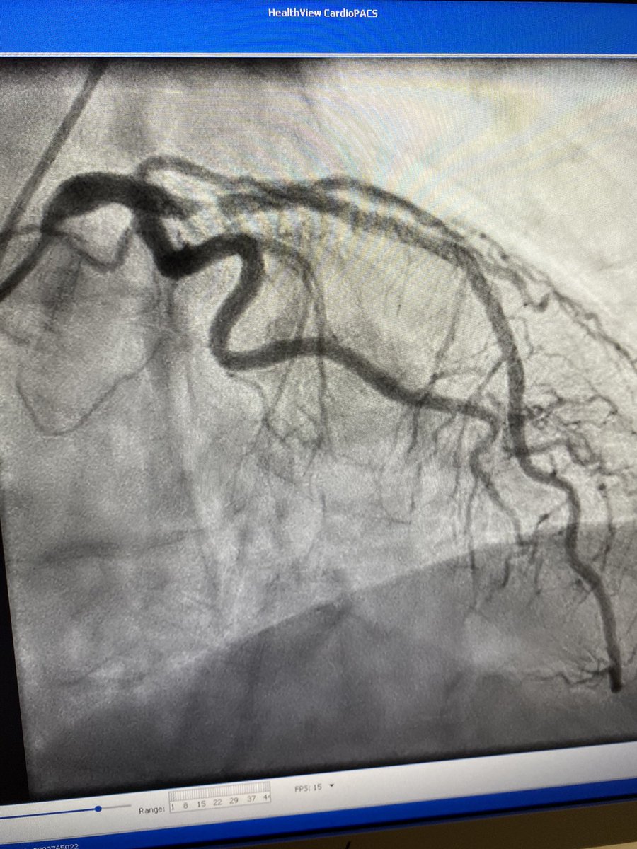 IVUS must be incorporated into you practice. 72 m with Recent LAD stent. Severe new denovo lesion at Prox stent edge. Stent placed 9 months prior.