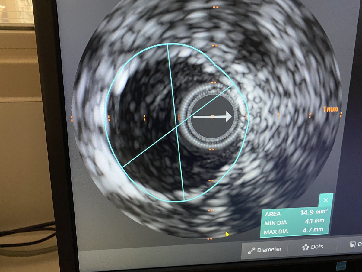 Dropped new stent 4.5mm and postdilated old stent to 4.25mm. Post IVUS with excellent expansion and no more malapposition. Looks grossly oversized on post angio.