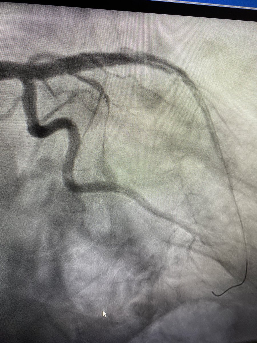 Dropped new stent 4.5mm and postdilated old stent to 4.25mm. Post IVUS with excellent expansion and no more malapposition. Looks grossly oversized on post angio.