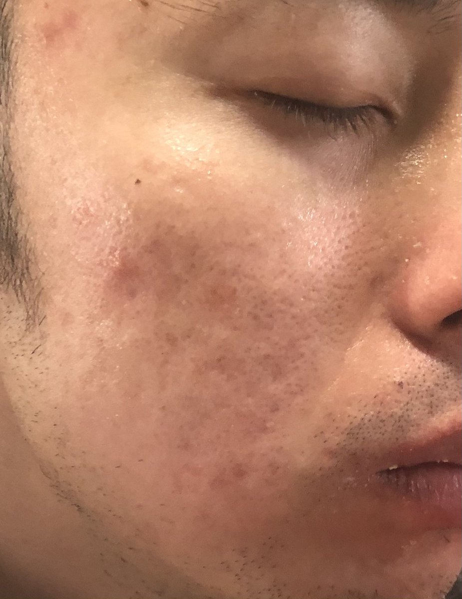肌中心の男 の赤みはあるが ニキビ自体は治まってきた 小鼻にトレチノイン0 1パーを塗っているので 皮むけがおきている ニキビ ニキビ跡 クレーター