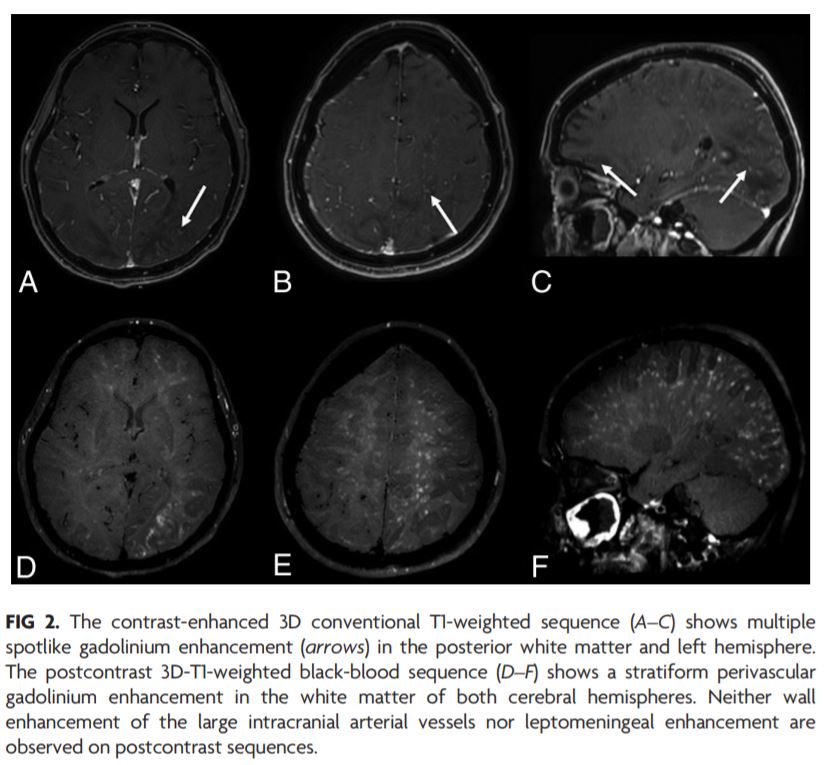 TheAJNR's tweet photo. "COVID-19–Associated PRES–like Encephalopathy with Perivascular Gadolinium Enhancement" | #NeuroRad #COVID19 @GiorgioConte86 https://t.co/fpaqgr9iJr https://t.co/VQb7HAsPyU