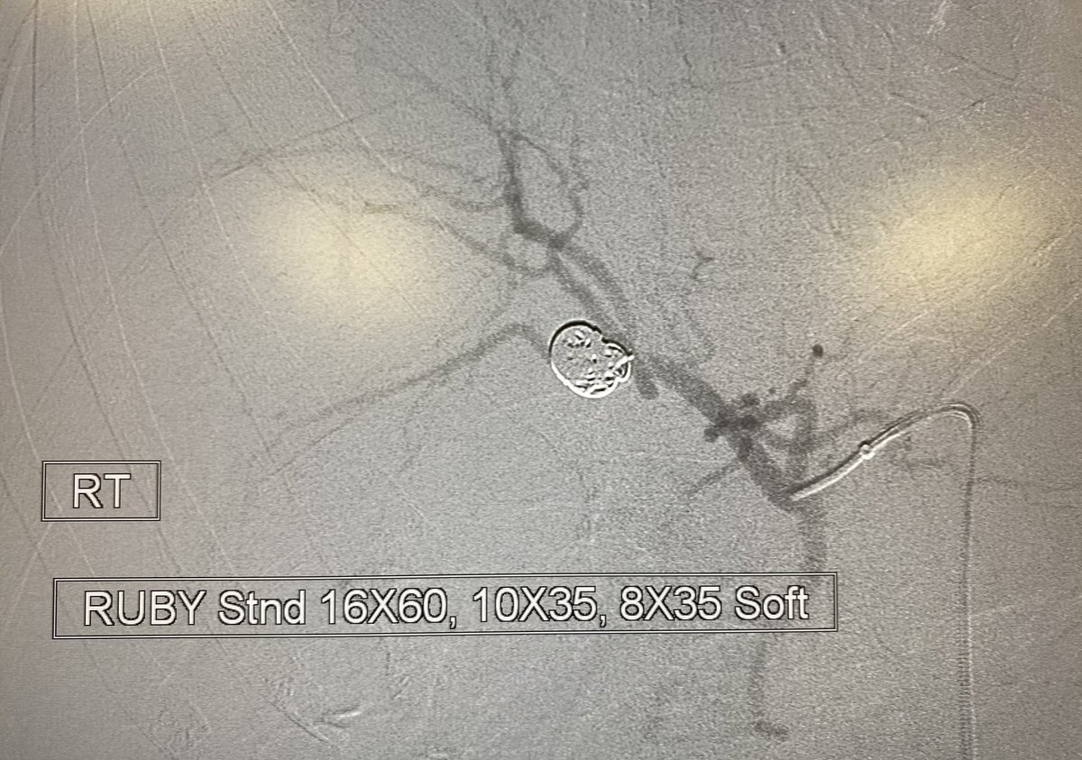 eliebalesh's tweet photo. Right hepatic arterial aneurysm, embolized with @PenVascular Ruby coils, preserving all inflow/outflow branches. #IRad https://t.co/LaI7wN2epW