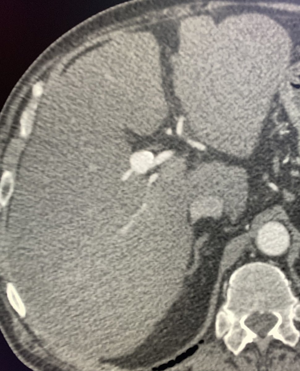eliebalesh's tweet photo. Right hepatic arterial aneurysm, embolized with @PenVascular Ruby coils, preserving all inflow/outflow branches. #IRad https://t.co/LaI7wN2epW